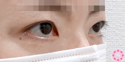 年代：30代 施術名：眼瞼下垂 施術前｜東京形成美容外科