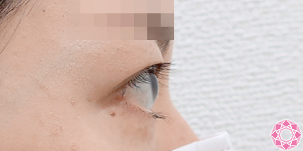 年代：30代 施術名：眼瞼下垂 施術前｜東京形成美容外科