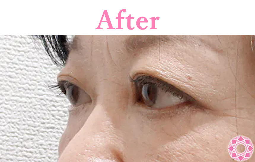 年代：50代 施術名：目の下のたるみ取り 施術後 拡大画像｜【公式】東京形成美容外科
