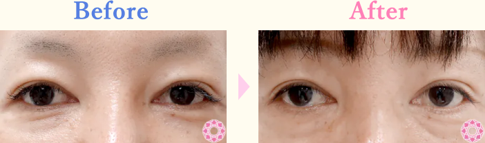 年代：40代 施術名：目の上（まぶた）の脂肪・ふくらみ取り 施術前後｜【公式】東京形成美容外科