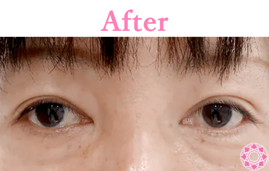 年代：40代 施術名：目の上（まぶた）の脂肪・ふくらみ取り 施術後 拡大画像｜【公式】東京形成美容外科