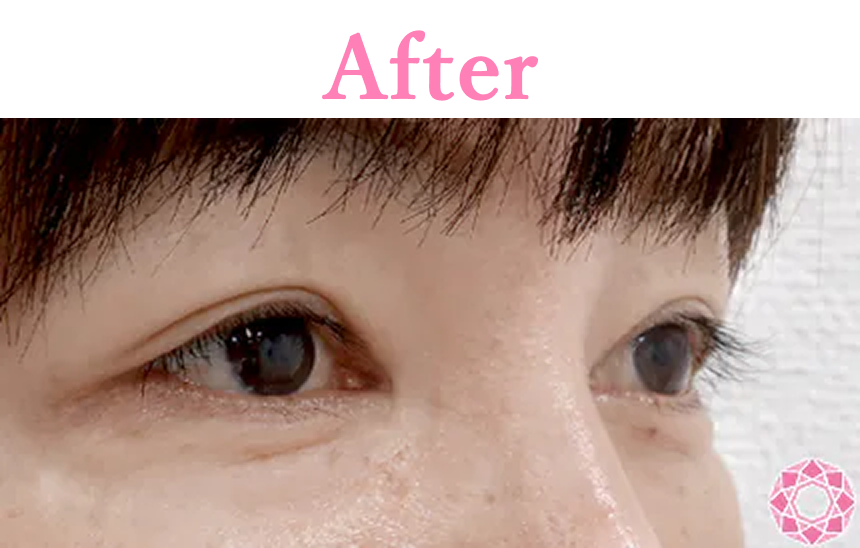 年代：40代 施術名：目の上（まぶた）の脂肪・ふくらみ取り 施術後 拡大画像｜【公式】東京形成美容外科