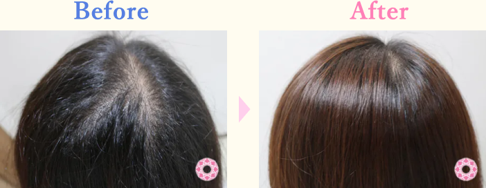 年代：20代 施術名：女性薄毛治療(発毛治療) 施術前後｜【公式】東京形成美容外科