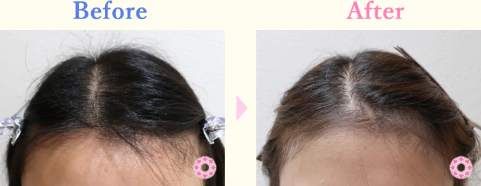 年代：20代 施術名：女性薄毛治療(発毛治療) 施術前後｜【公式】東京形成美容外科