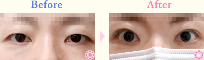年代：30代 施術名：眼瞼下垂 施術前後｜【公式】東京形成美容外科