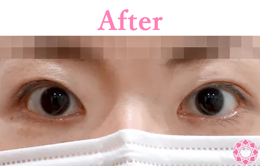 年代：30代 施術名：眼瞼下垂 施術後 拡大画像｜【公式】東京形成美容外科