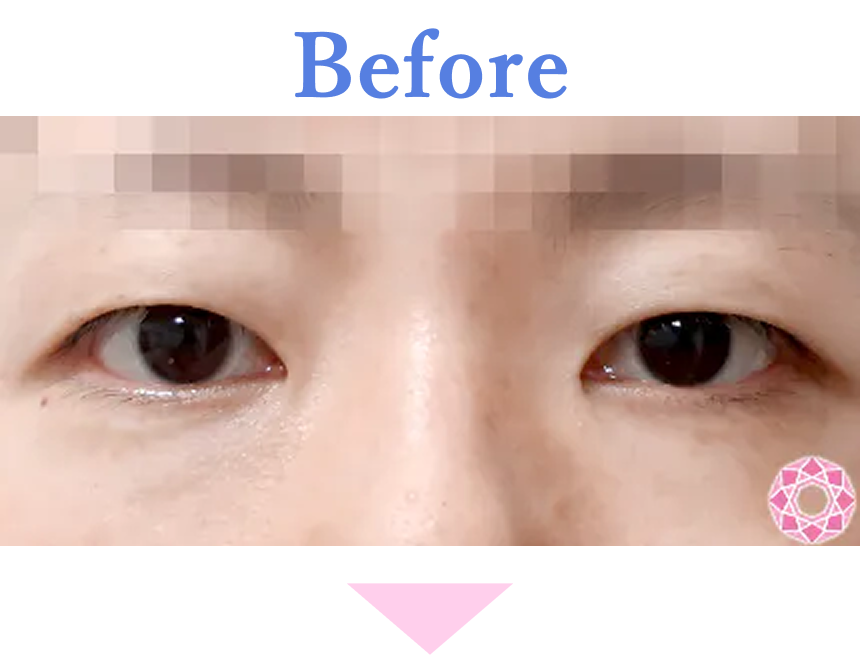 年代：30代 施術名：眼瞼下垂 施術前 拡大画像｜【公式】東京形成美容外科