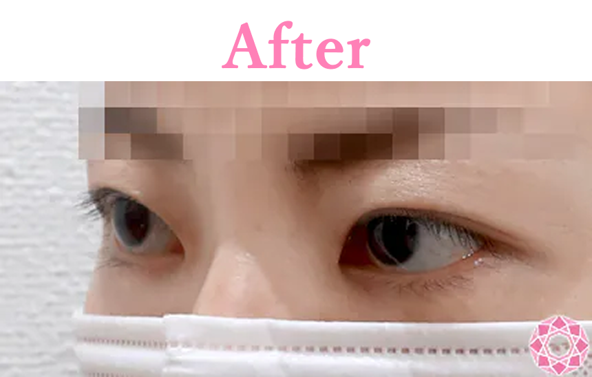 年代：30代 施術名：眼瞼下垂 施術後 拡大画像｜【公式】東京形成美容外科