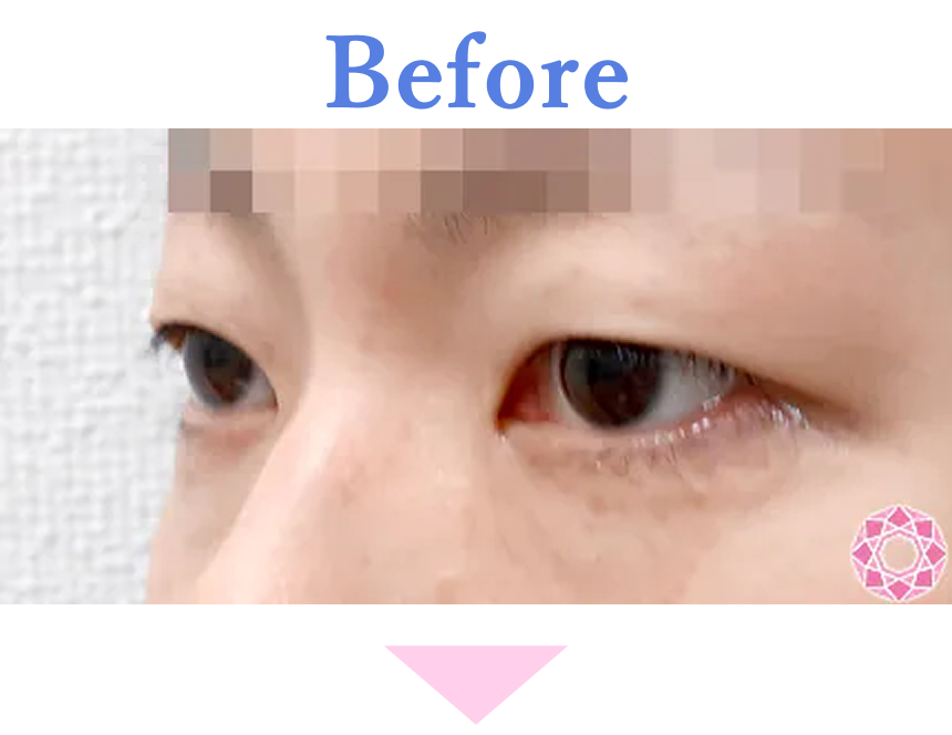 年代：30代 施術名：眼瞼下垂 施術前 拡大画像｜【公式】東京形成美容外科