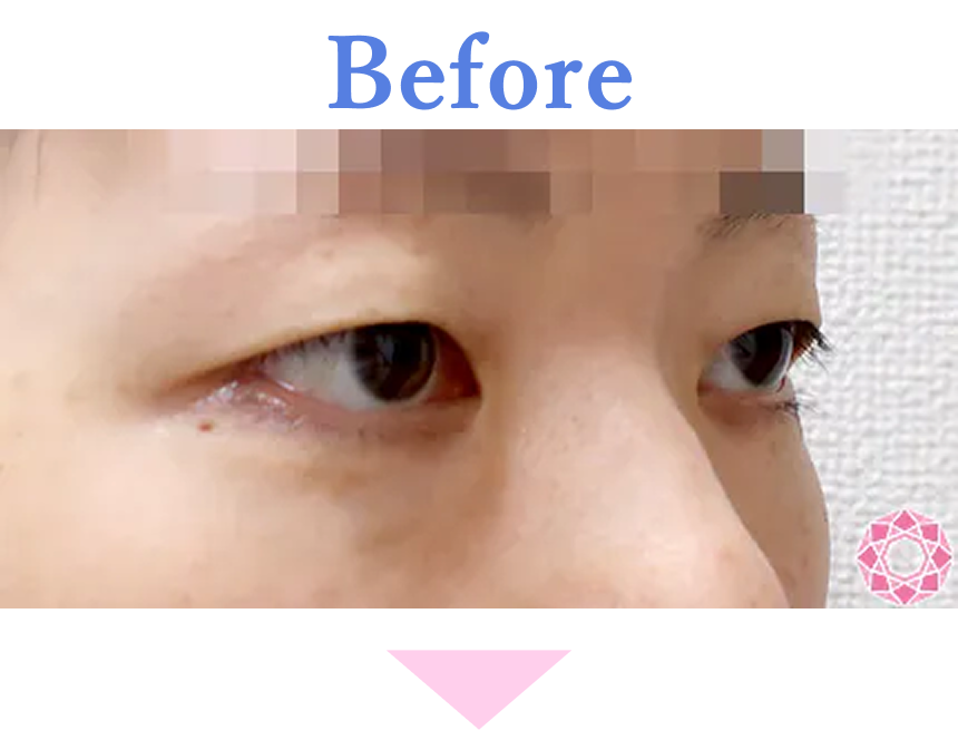 年代：30代 施術名：眼瞼下垂 施術前 拡大画像｜【公式】東京形成美容外科