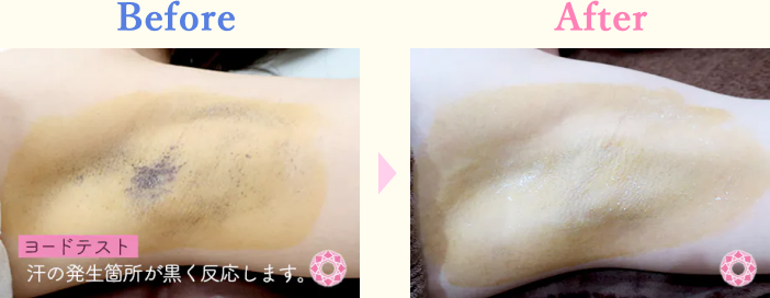 年代：30代 施術名：ミラドライ 施術前後｜【公式】東京形成美容外科