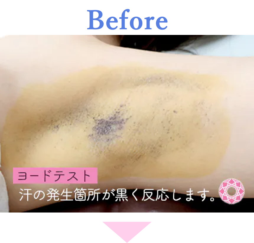 年代：30代 施術名：ミラドライ 施術前 拡大画像｜【公式】東京形成美容外科
