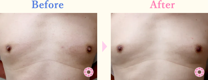 年代：40代 施術名：乳頭縮小・乳頭縮小（乳管温存法） 施術前後｜【公式】東京形成美容外科