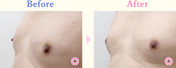 年代：40代 施術名：乳頭縮小・乳頭縮小（乳管温存法） 施術前後｜【公式】東京形成美容外科