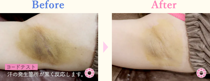 年代：20代 施術名：ミラドライ 施術前後｜【公式】東京形成美容外科