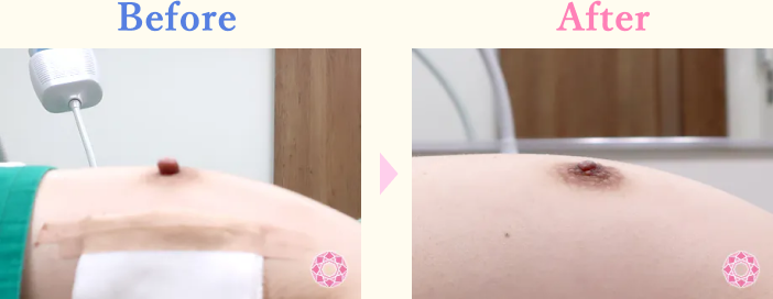年代：40代 施術名：乳頭縮小・乳頭縮小（乳管温存法） 施術前後｜【公式】東京形成美容外科