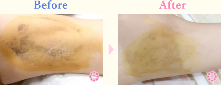 年代：20代 施術名：ミラドライ 施術前後｜【公式】東京形成美容外科