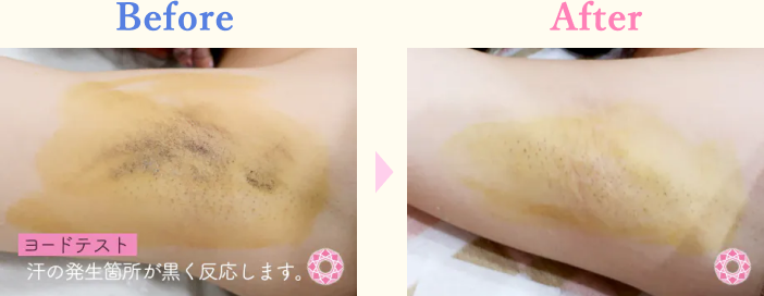 年代：20代 施術名：ミラドライ 施術前後｜【公式】東京形成美容外科