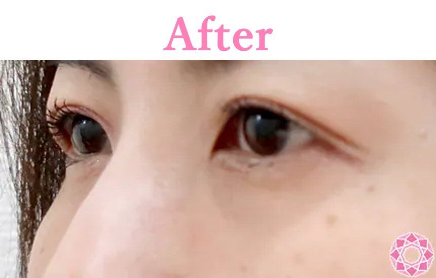年代：30代 施術名：目の下のふくらみ取り 施術後 拡大画像｜【公式】東京形成美容外科