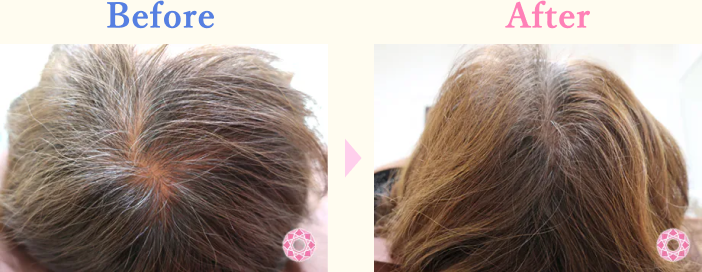 年代：50代 施術名：女性薄毛治療(発毛治療) 施術前後｜【公式】東京形成美容外科