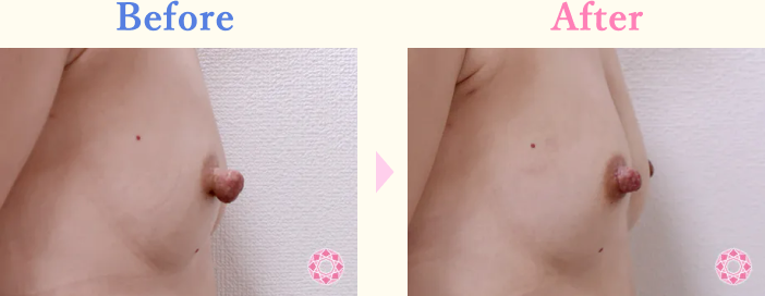 年代：30代 施術名：乳頭縮小・乳頭縮小（乳管温存法） 施術前後｜【公式】東京形成美容外科