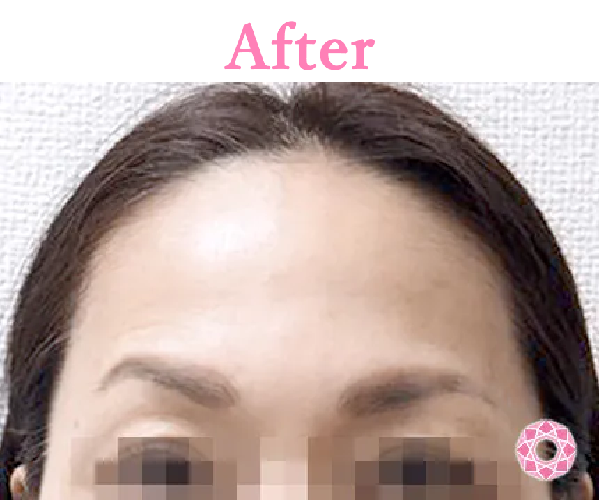 年代：50代 施術名：シワ取り（ボトックス） 施術後 拡大画像｜【公式】東京形成美容外科