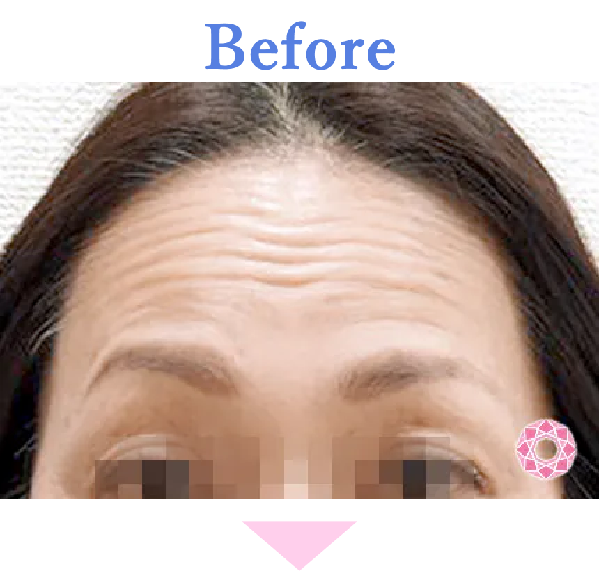 年代：50代 施術名：シワ取り（ボトックス） 施術前 拡大画像｜【公式】東京形成美容外科