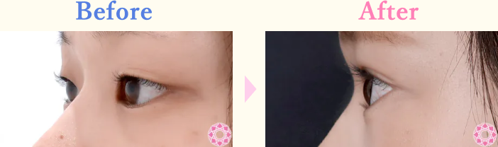 年代：20代 施術名：二重埋没法 施術前後｜【公式】東京形成美容外科