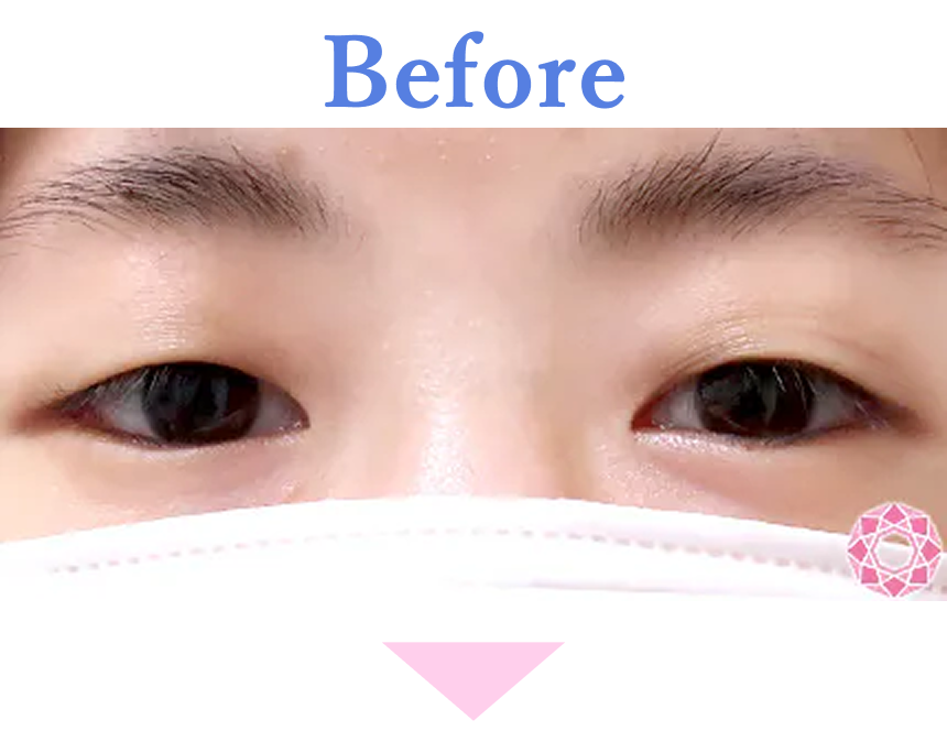 年代：20代 施術名：二重埋没法 施術前 拡大画像｜【公式】東京形成美容外科