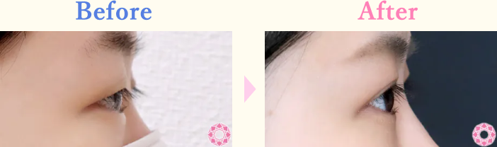 年代：20代 施術名：二重埋没法 施術前後｜【公式】東京形成美容外科