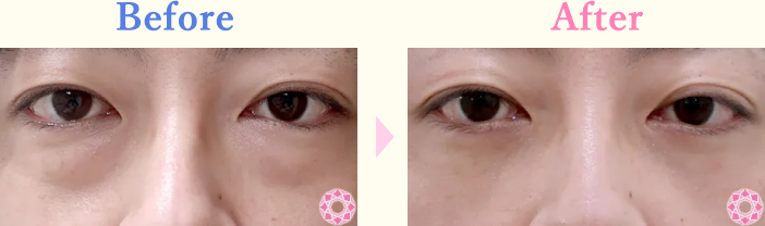 年代：30代 施術名：目の下のふくらみ取り 施術前後｜【公式】東京形成美容外科
