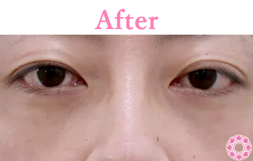 年代：30代 施術名：目の下のふくらみ取り 施術後 拡大画像｜【公式】東京形成美容外科