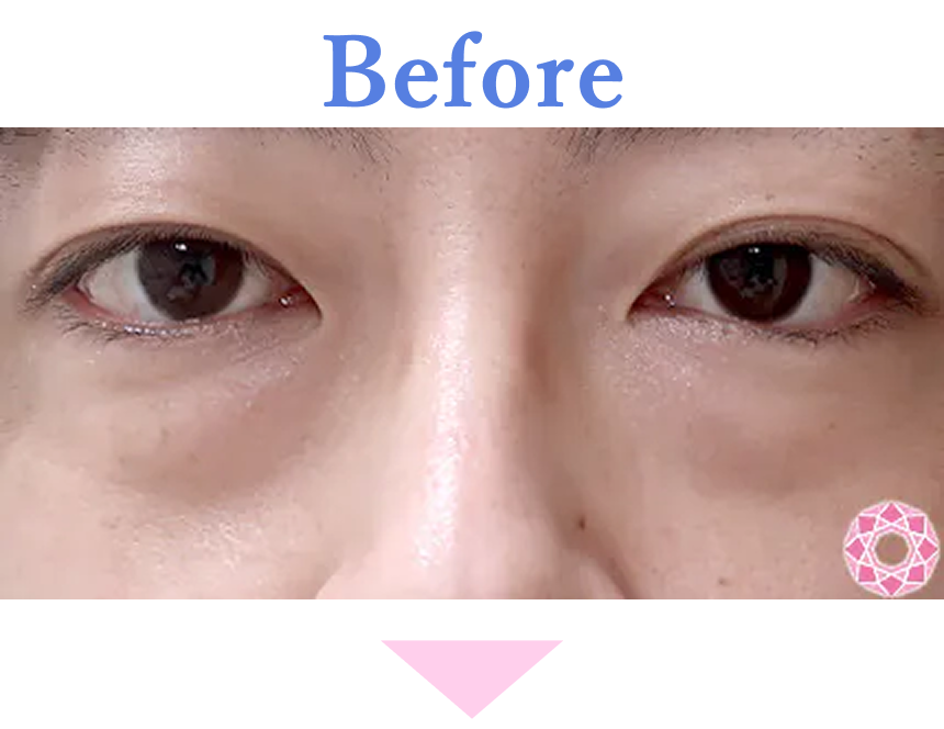 年代：30代 施術名：目の下のふくらみ取り 施術前 拡大画像｜【公式】東京形成美容外科