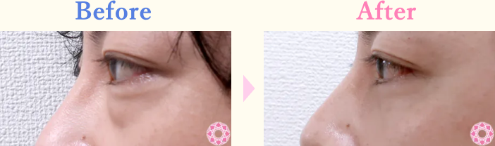 年代：30代 施術名：目の下のふくらみ取り 施術前後｜【公式】東京形成美容外科