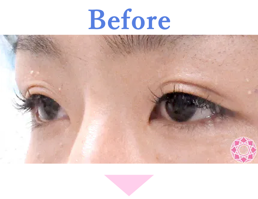 年代：20代 施術名：二重埋没法 施術前 拡大画像｜【公式】東京形成美容外科