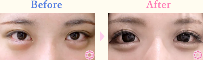 年代：30代 施術名：たれ目形成 施術前後｜【公式】東京形成美容外科