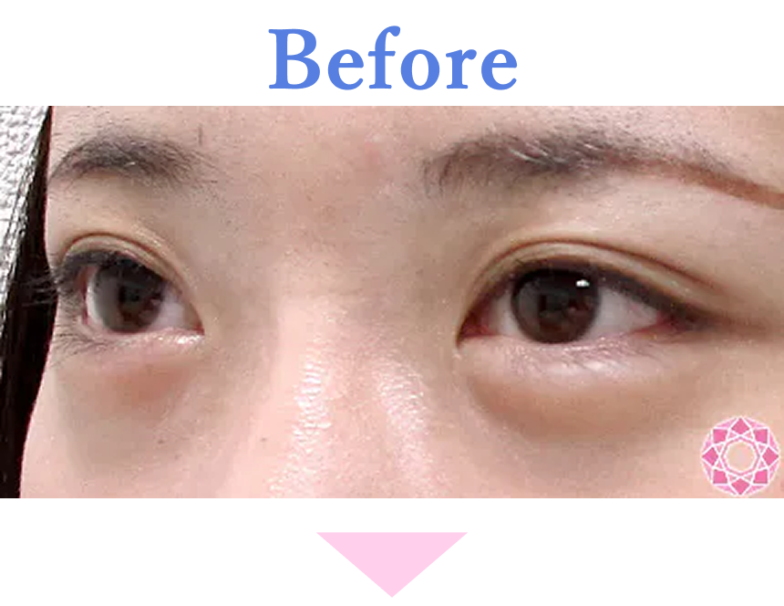 年代：30代 施術名：たれ目形成 施術前 拡大画像｜【公式】東京形成美容外科