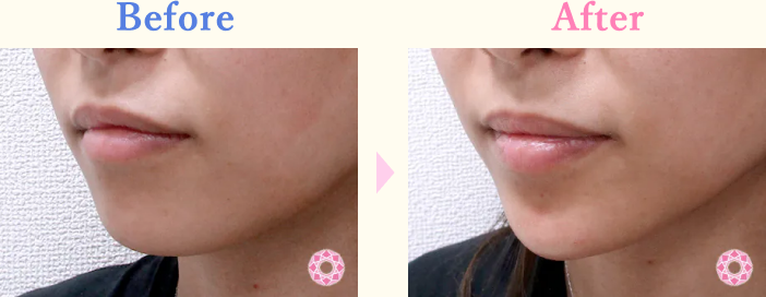 年代：20代 施術名：1DayクイックEライン 施術前後｜【公式】東京形成美容外科