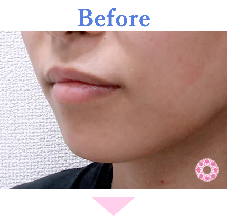 年代：20代 施術名：1DayクイックEライン 施術前 拡大画像｜【公式】東京形成美容外科