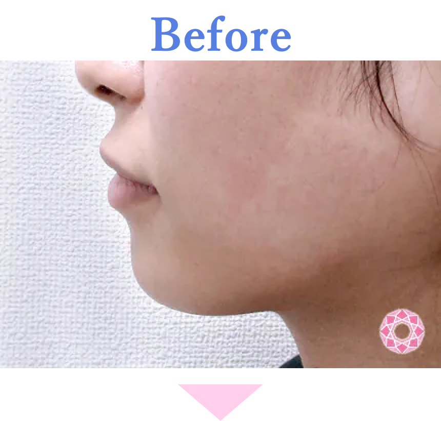 年代：20代 施術名：1DayクイックEライン 施術前 拡大画像｜【公式】東京形成美容外科