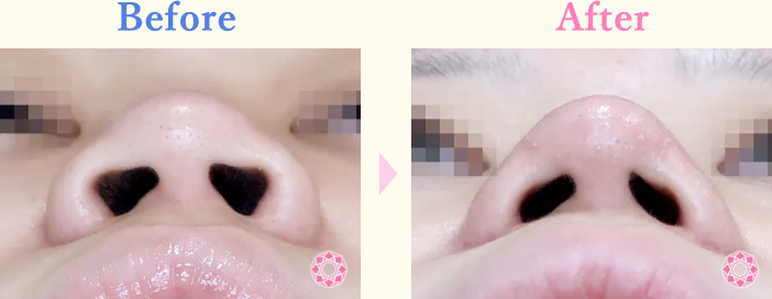 年代：10代 施術名：鼻先（ダンゴ鼻）修正 施術前後｜【公式】東京形成美容外科