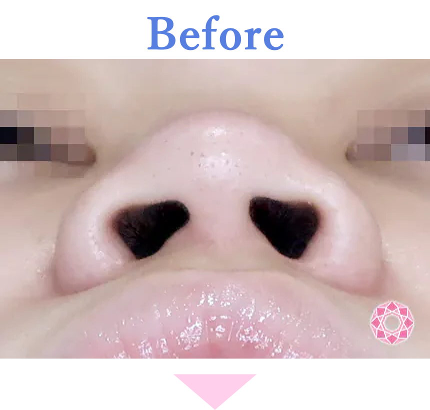 年代：10代 施術名：鼻先（ダンゴ鼻）修正 施術前 拡大画像｜【公式】東京形成美容外科