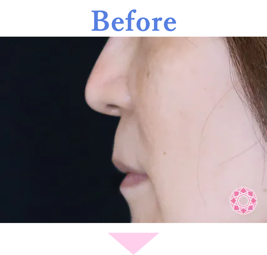 年代：50代 施術名：人中短縮(リップリフト) 施術前 拡大画像｜【公式】東京形成美容外科