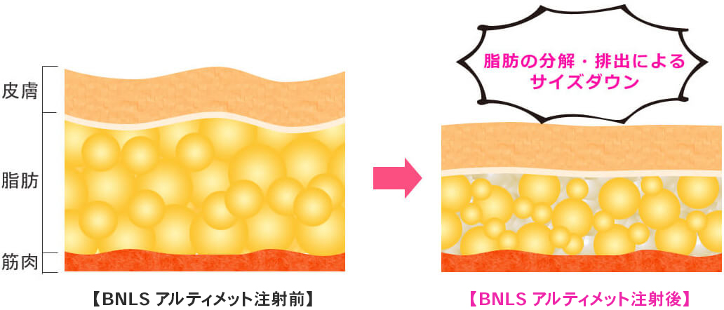 脂肪溶解注射 カベリン Fatx Core Bnls アルティメット 美容整形のことなら千葉県船橋市の東京形成美容外科 美容皮膚科 船橋駅から徒歩3分 脂肪溶解注射 カベリン Fatx Core Bnls アルティメット 美容整形のことなら千葉県船橋市の東京形成美容外科 美容皮膚科 船橋駅から徒歩3分