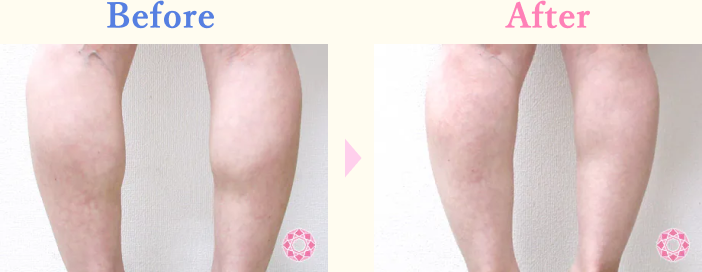 年代：30代 施術名：美脚ボトックス 施術前後｜【公式】東京形成美容外科