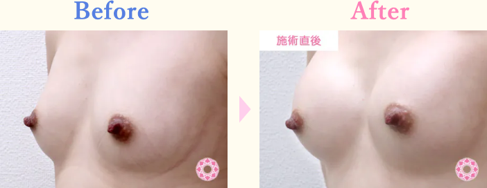 年代：20代 施術名：ヒアルロン酸による豊胸術 施術前後｜【公式】東京形成美容外科