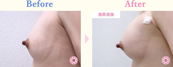 年代：20代 施術名：ヒアルロン酸による豊胸術 施術前後｜【公式】東京形成美容外科