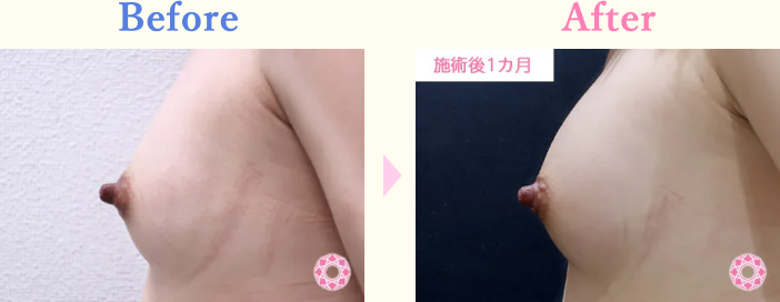 年代：20代 施術名：ヒアルロン酸による豊胸術 施術前後｜【公式】東京形成美容外科