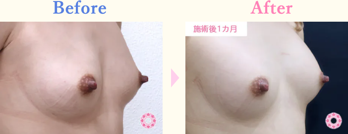 年代：20代 施術名：ヒアルロン酸による豊胸術 施術前後｜【公式】東京形成美容外科