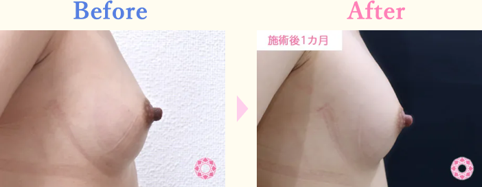 年代：20代 施術名：ヒアルロン酸による豊胸術 施術前後｜【公式】東京形成美容外科